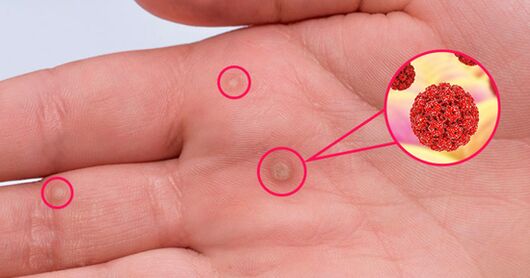 Die Niederlage der Handfläche der Papillome